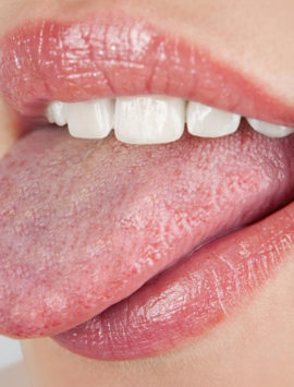 Mouth & Tongue Diseases